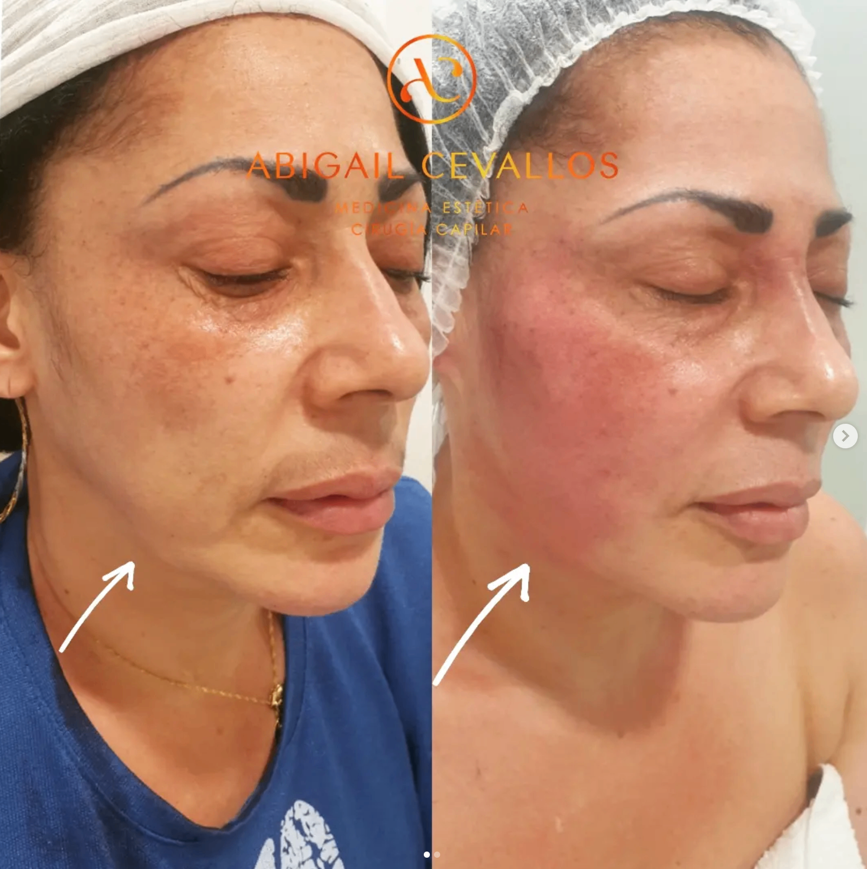 Antes y después · Armonización facial personalizada por la Dra. Abigail Cevallos