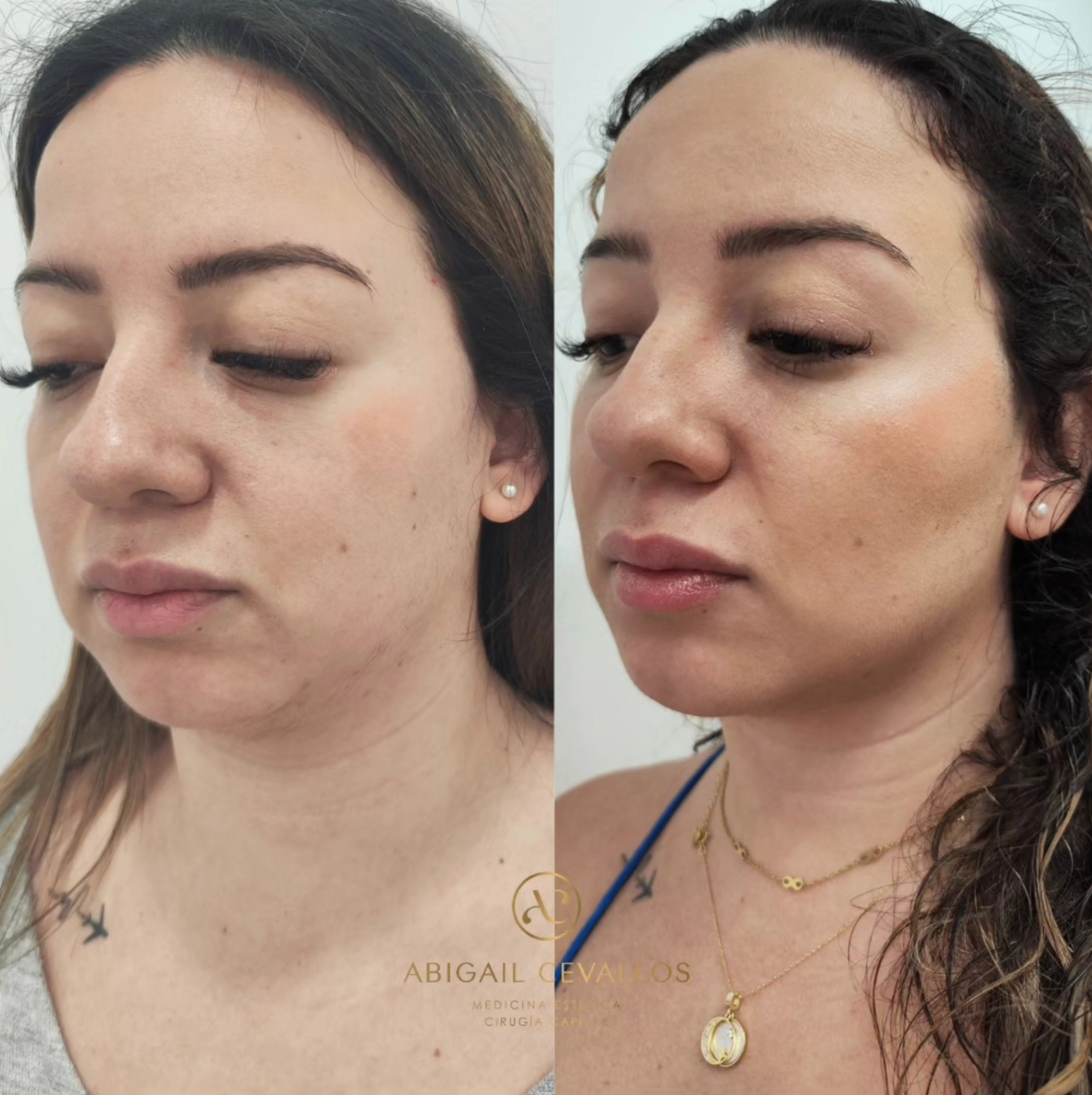 Contorno mandibular · resultado antes y después