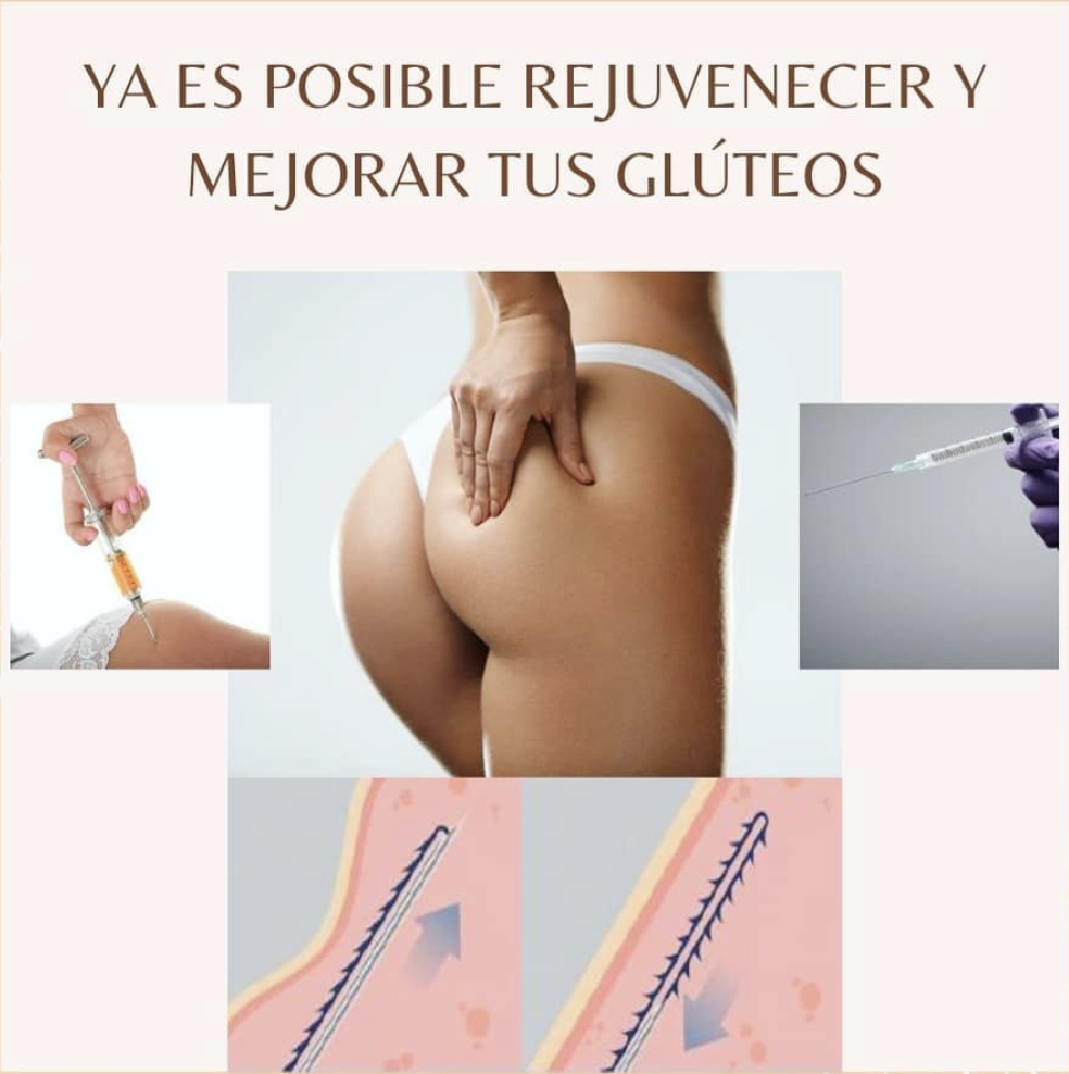 Protocolo de Alta Definición Glútea · Endoláser, Sculptra e hilos tensores