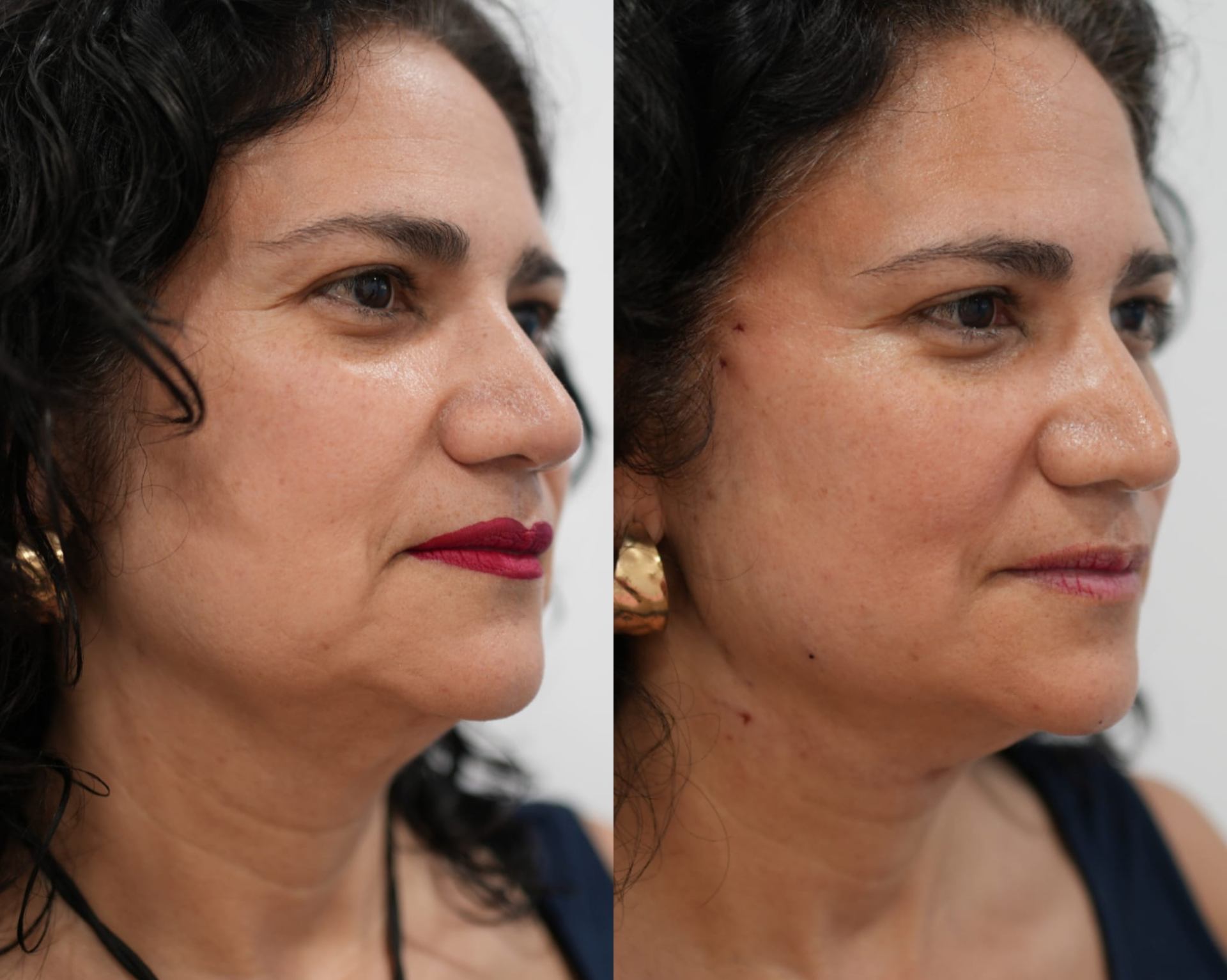 Resultado real antes y después · redefinición del óvalo facial