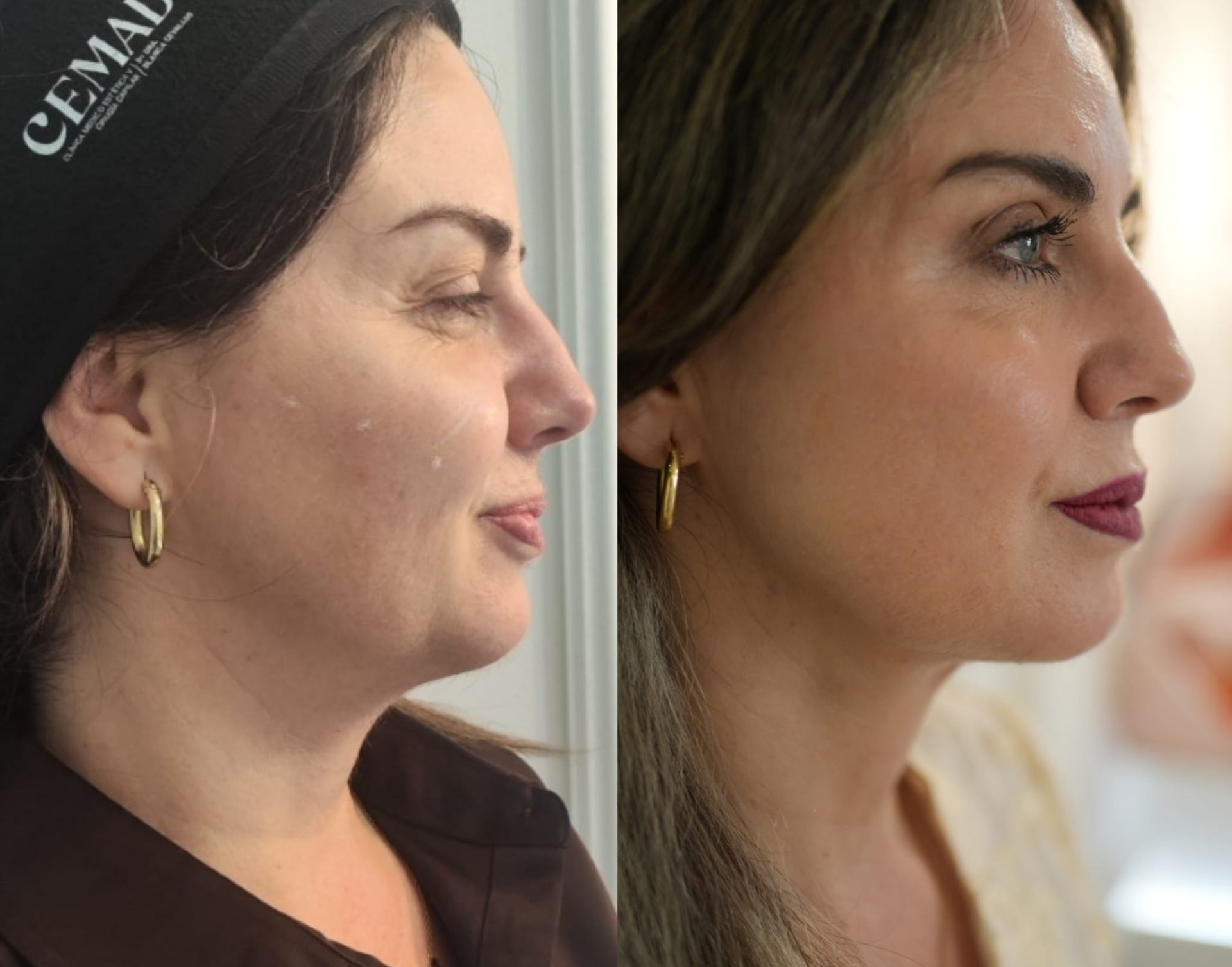 Resultado real antes y después · tensado facial y luminosidad
