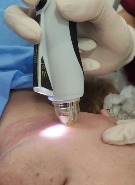 Tensado cutáneo subdérmico · neocolagénesis profunda