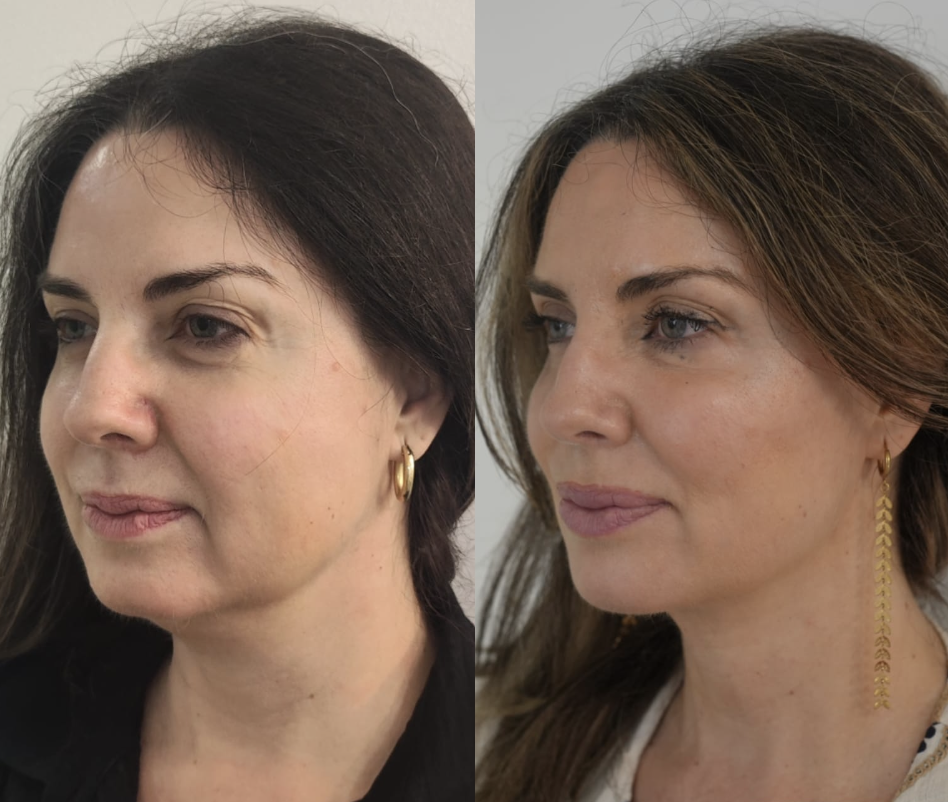 Transformación real con Endoláser Avanzado · óvalo facial redefinido y piel tensada