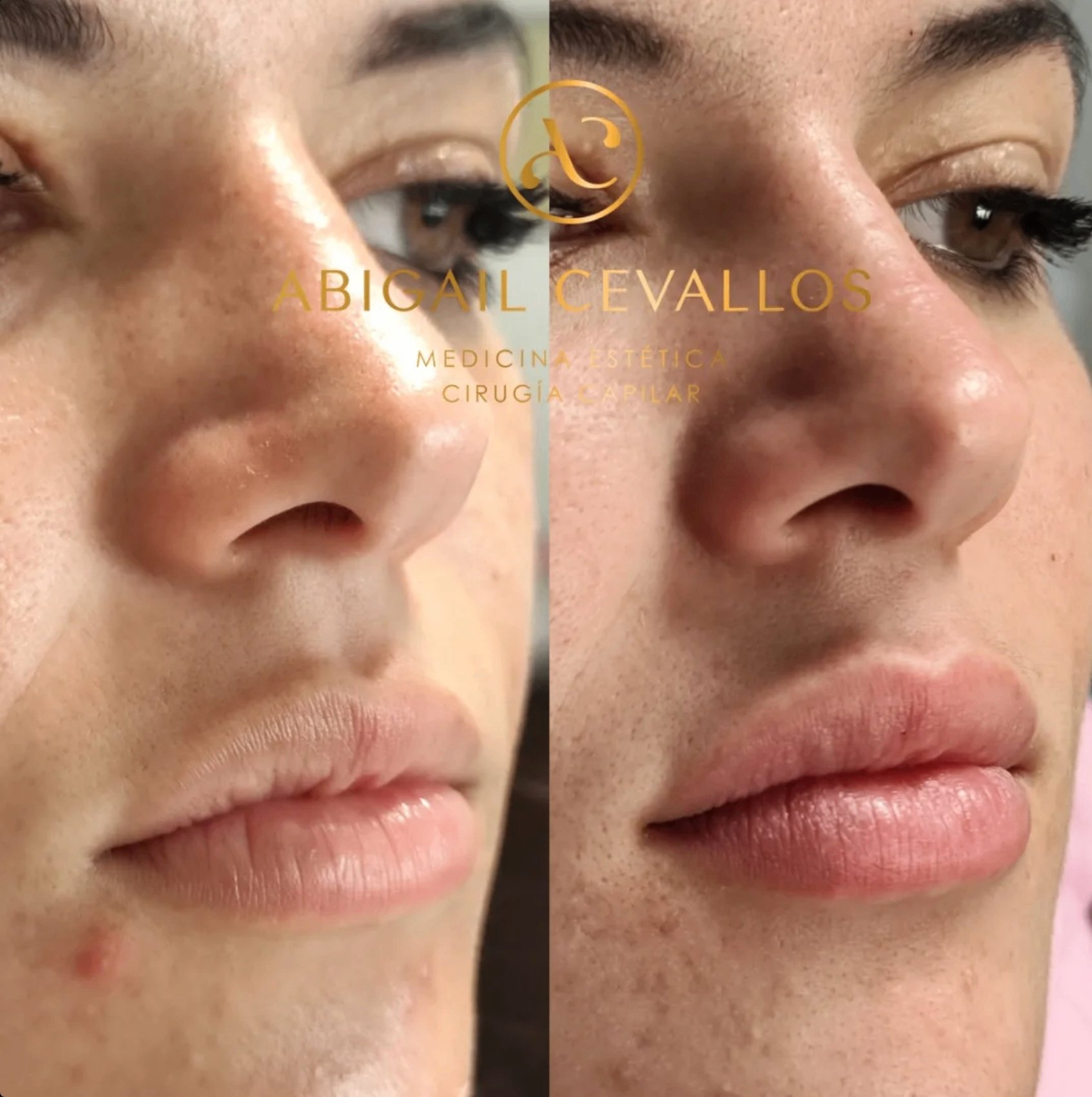 Antes y después · Diseño de labios Cupido por la Dra. Abigail Cevallos