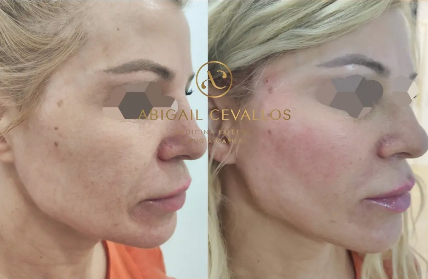 Antes y después · Reposición de volúmenes facial por la Dra. Abigail Cevallos